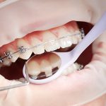 stomatološka ordinacija Čeović trajanje ortodontske terapije