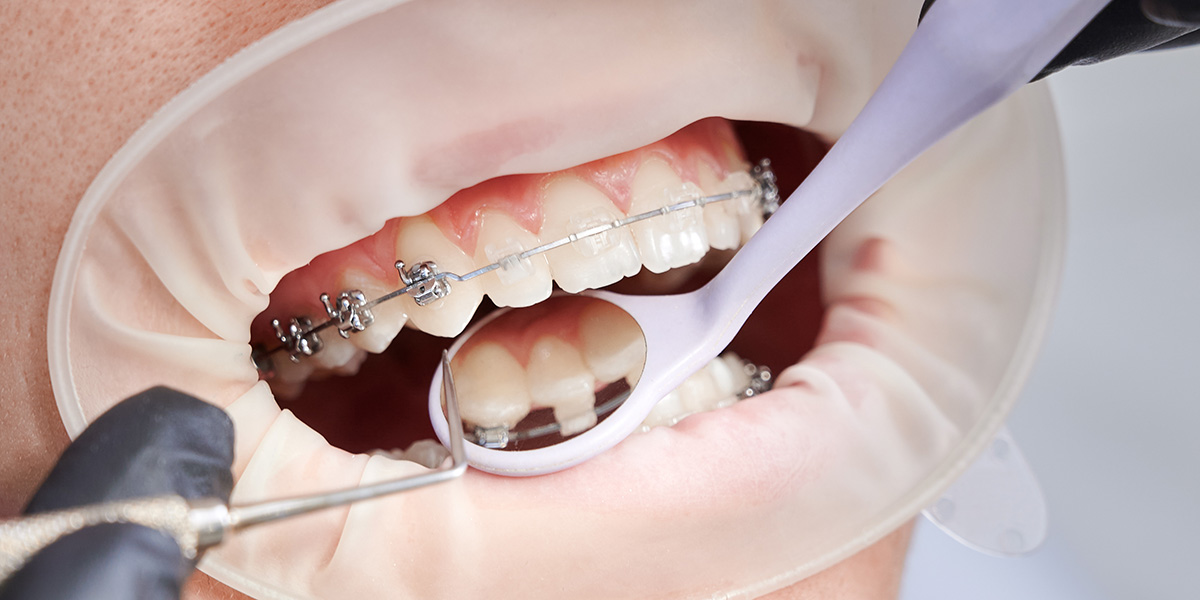 stomatološka ordinacija Čeović trajanje ortodontske terapije