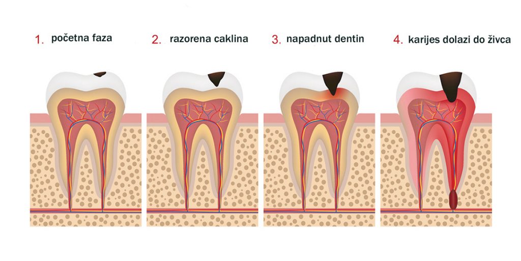 stomatološka ordinacija Čeović - karijes
