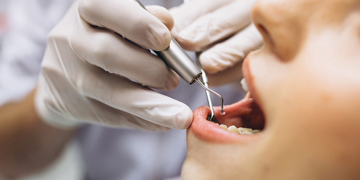 stomatološka ordinacija Čeović kako se riješiti zubnog kamenca