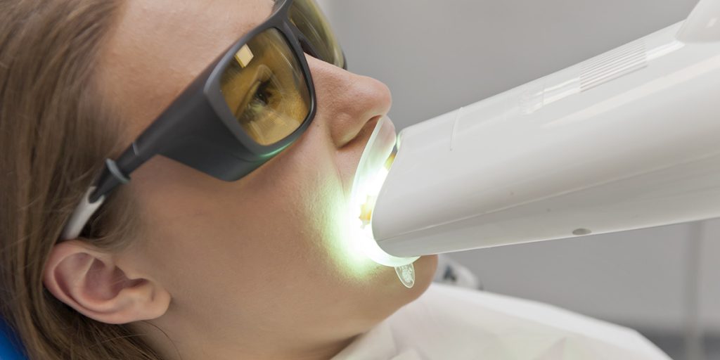 stomatološka ordinacija Čeović izbjeljivanje zubi