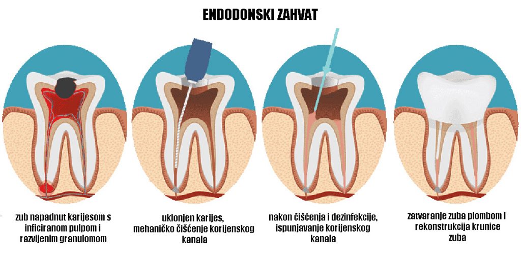 stomatološka ordinacija Čeović - granulom zuba