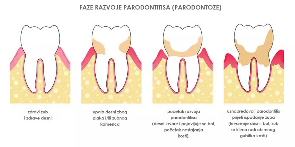 stomatološka ordinacija Čeović -parodontoza