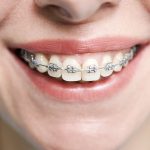 stomatološka ordinacija Čeović ortodoncija u odrasloj dobi