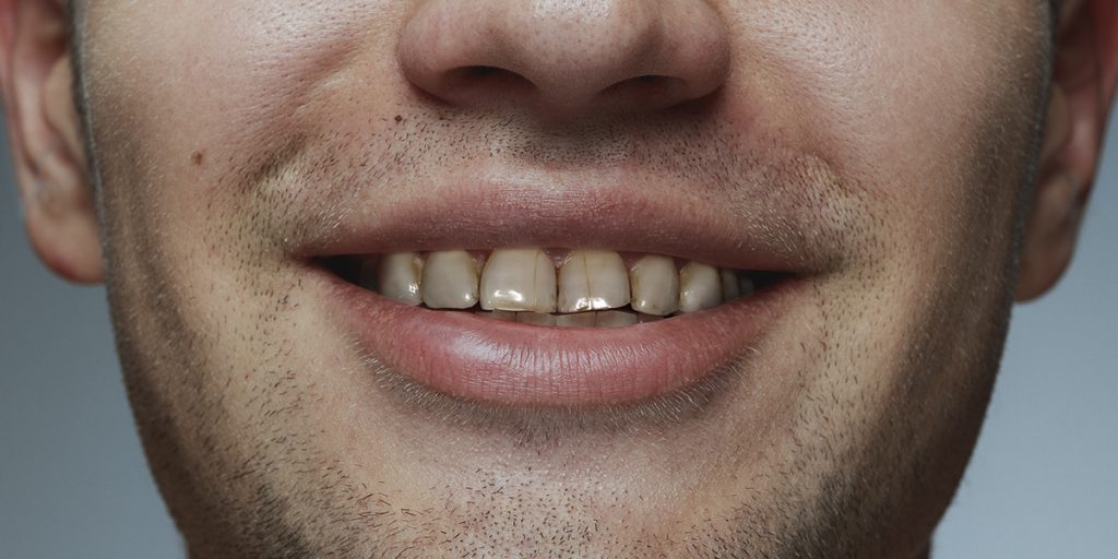 stomatološka ordinacija Čeović pukotine na caklini zuba