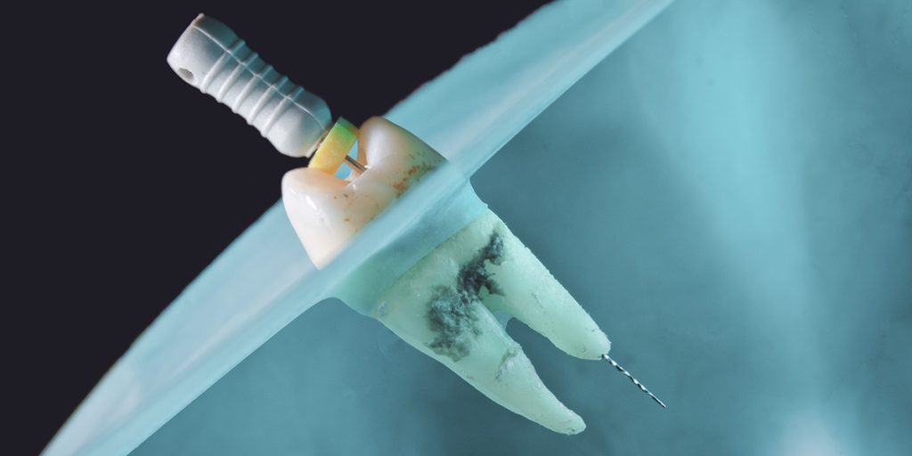 stomatološka ordinacija Čeović endodoncija
