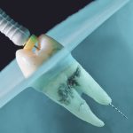 stomatološka ordinacija Čeović endodoncija