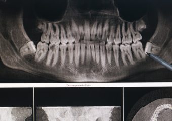 stomatološka ordinacija Čeović problemi s umnjacima