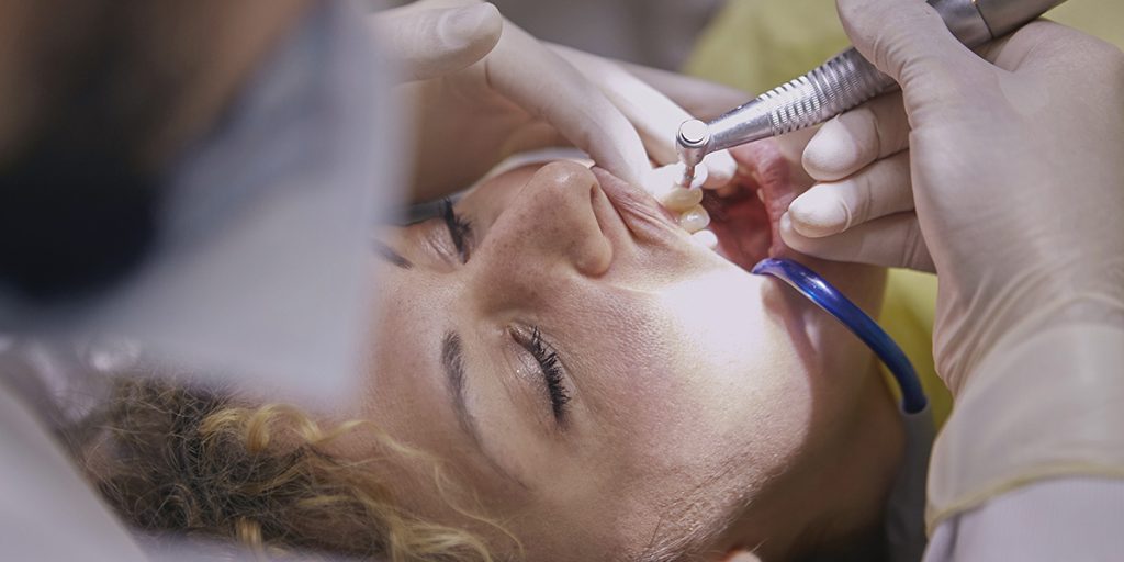 stomatološka ordinacija Čeović poliranje zubi