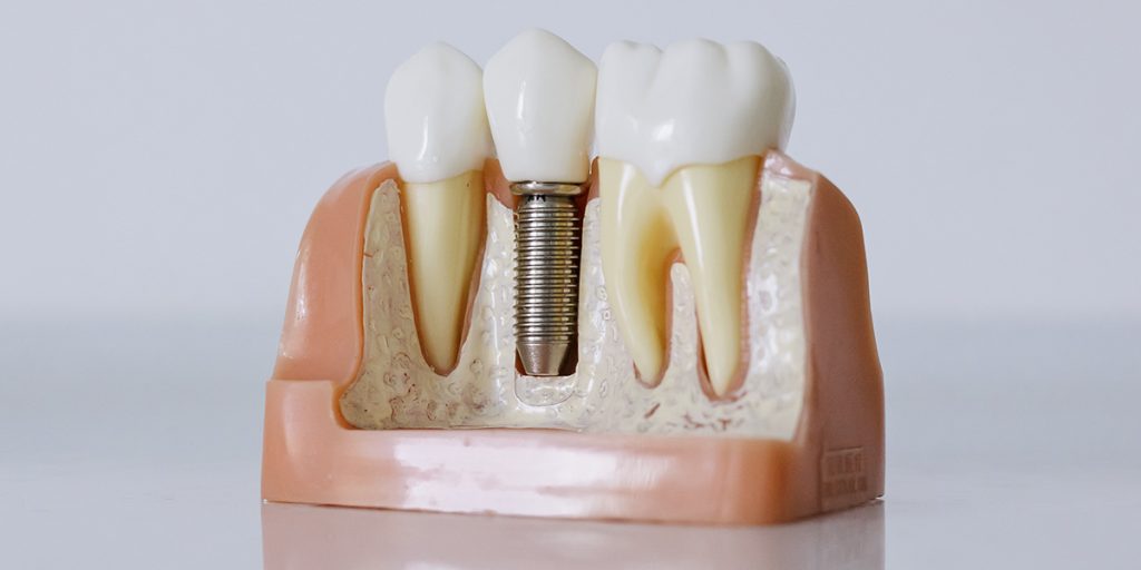 stomatološka ordinacija Čeović implantat