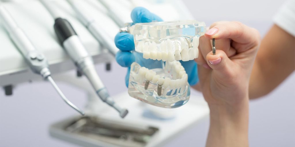 stomatološka ordinacija Čeović-ugradnja implantata