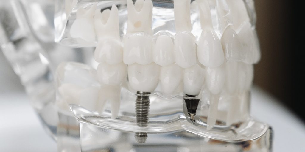 stomatološka ordinacija Čeović zubni implantat