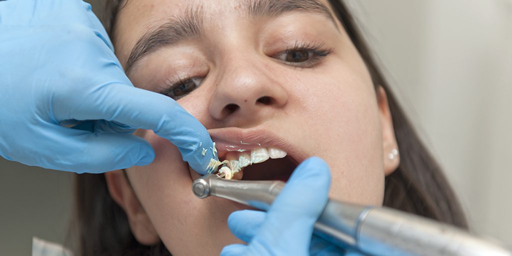 stomatološka ordinacija Čeović poliranje zubi