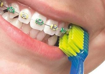 stomatološka ordinacija Čeović curaprox cs 5460 ortho